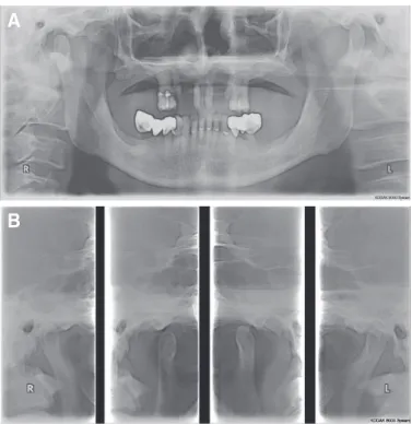 Fig. 3. Electronic surveying on diagnostic model of mandible shows degree of undercut by different color
