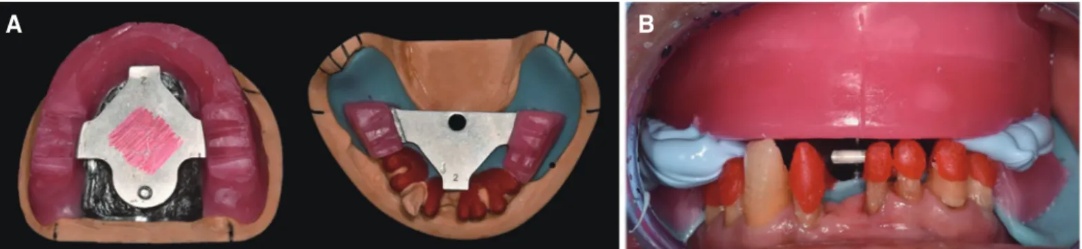 Fig. 5. Jaw relation record using Gothic arch tracer. (A) Wax-rim with Gothic arch tracing, (B) Bite registration.