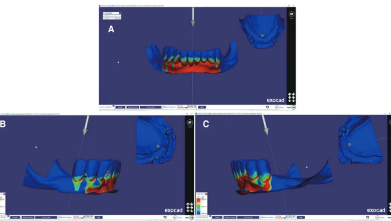 Fig. 6. Electronic surveying on mandibular surveyed crowns shows ideal undercut degrees of retentive arms
