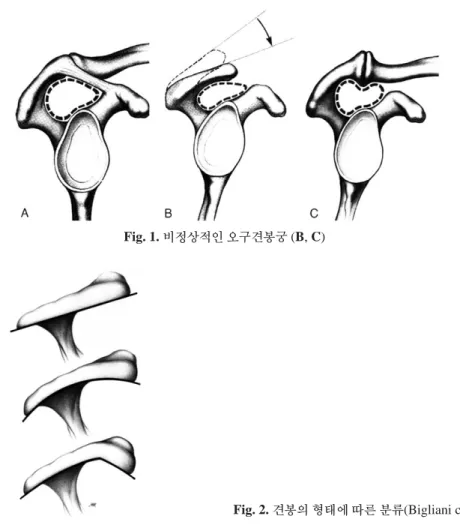 Fig. 1. 비정상적인 오구견봉궁 (B, C)