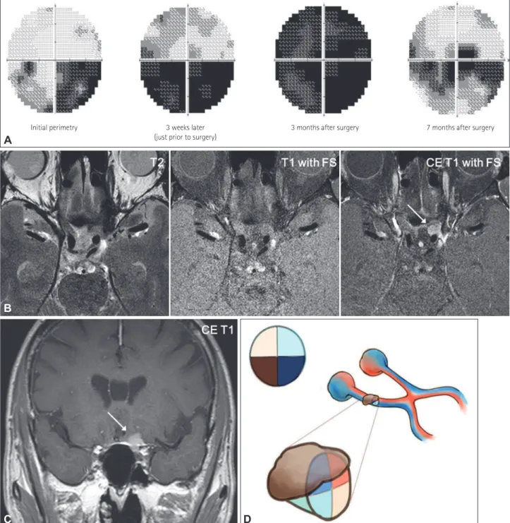 Fig. 1. Serial Humphrey perimetries and high-resolution MRI of compressive optic neuropathy with a monocular inferior altitudinal visual field  defect (VFD)