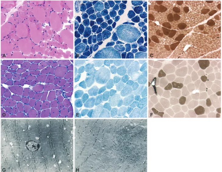 Fig. 3. Muscle pathology in patients 5 and 6. In patient 5, nuclear centralization and internalization were mostly found in the small fibers in  H&amp;E staining (A), and nonreactive regions for NADH-TR were observed in some fibers (B)
