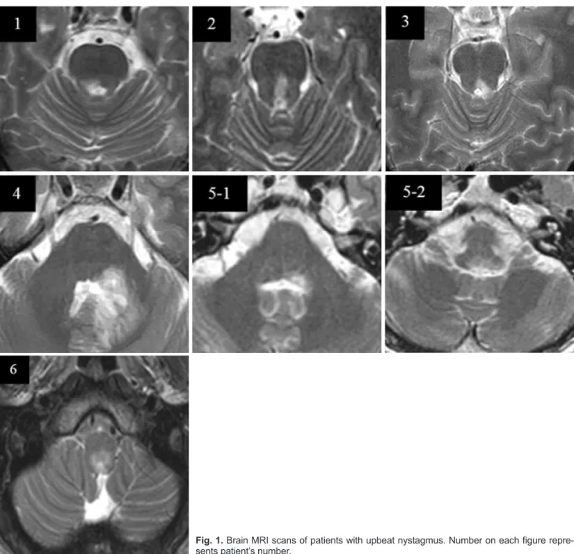 Fig. 1. Brain MRI scans of patients with upbeat nystagmus. Number on each figure repre- repre-sents patient’s number.