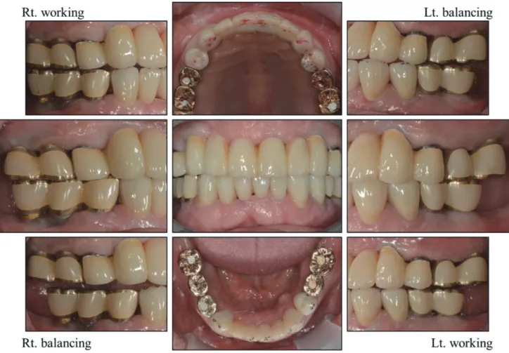 Fig. 16. Definitive prosthesis showing harmonious occlusal relationship. 
