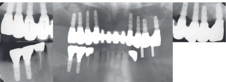 Fig. 6. (A) Lateral cephalometric radiograph, (B) Transcranial radiograph. Hypermobility of the left condyle and no specific findings related with pathologic  bony change in both TMJs.