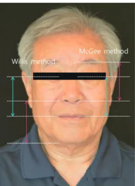 Fig. 7. Evaluation of occlusal vertical dimension using the Willis method  and the McGee method.