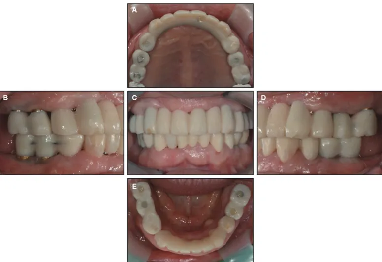 Fig. 12. Occlusal morphology changes of provisional restoration after 2  months. (A) Curve of Spee, (B) Curve of Wilson