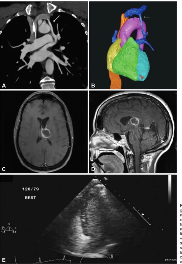 Fig. 1. A: Computed tomography an- an-giogram of the chest. Arrow indicates  an anomalous pulmonary venous  con-nection
