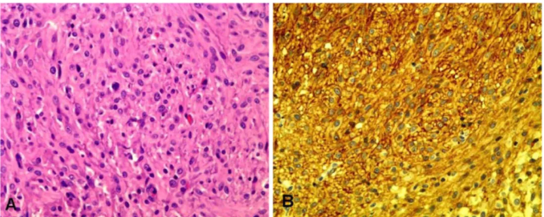Fig. 5.  Microscopically, the mass is composed of cells arranged haphazardly and in interlacing bundles and small whorls supported by a fine fibrovascular stroma