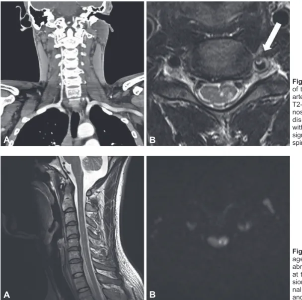Fig. 1. A: Severe stenosis and occlusion  of the proximal part of the left vertebral  artery in a neck CT angiogram