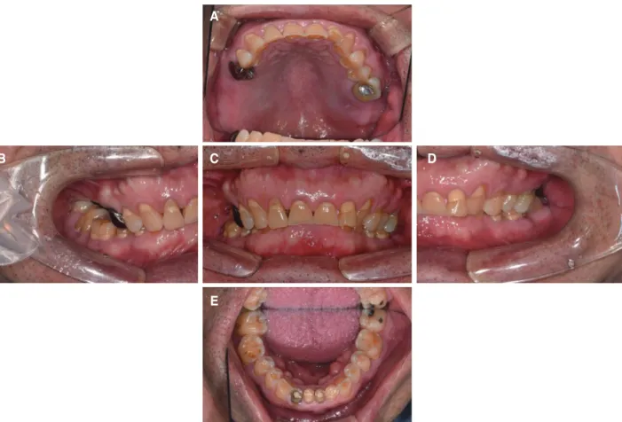 Fig. 1. Intraoral photograph before treatment. (A) Upper, (B) Right, (C) Frontal, (D) Left, (E) Lower.
