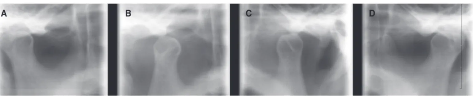 Fig. 3. TMJ series before treatment. (A) Rt. close, (B) Rt. opening, (C) Lt. opening, (D) Lt