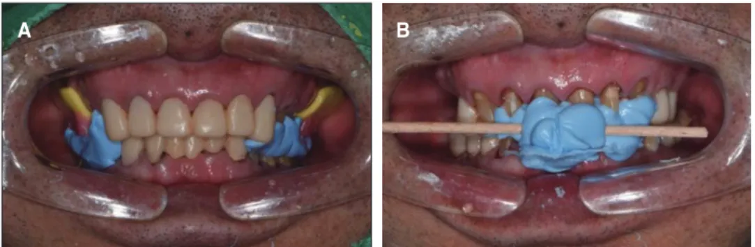 Fig. 8. Interocclusal relationship registrations using provisional restorations. (A) Registration of posterior restoration, (B) Registration of anterior restoration.