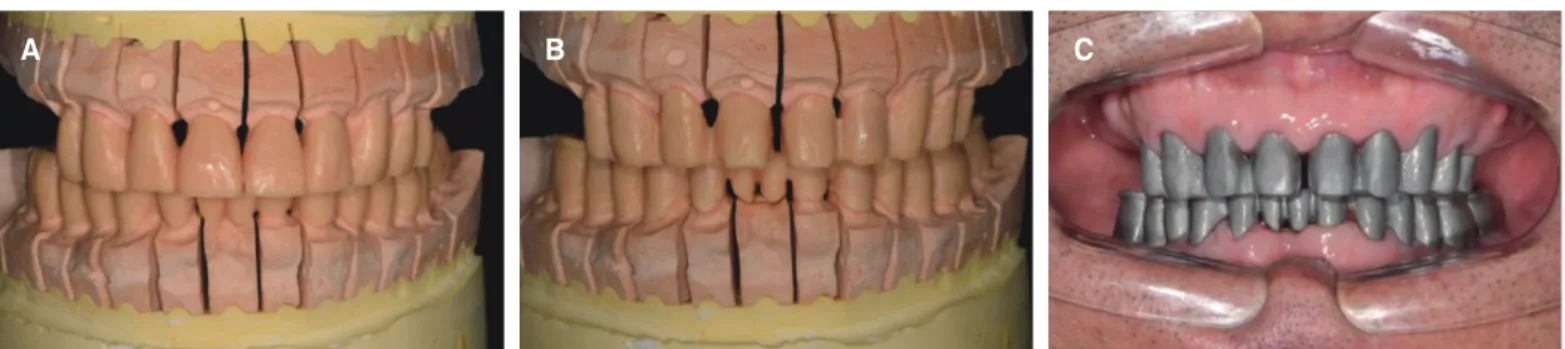 Fig. 9. Full contour wax-up &amp; cut back &amp; coping try in. (A) Full contour wax-up (B) Cut back (C) Coping try in.