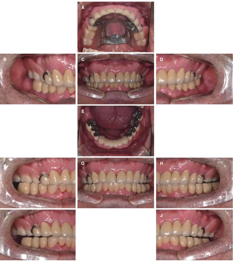 Fig. 12. Definitive prosthesis. (A) Upper, (B) Right, (C) Frontal, (D) Left, (E) Lower, (F) Right working, (G) Protrusive, (H) Left working, (I) Right balancing, (J)  Left balancing.BFI CEG DHJ