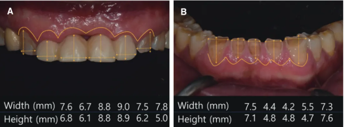 Fig. 4. Analysis of cephalometric projection. (A) Lateral cephalometric radiograph, (B) Tracing of lateral cephalometric radiograph.