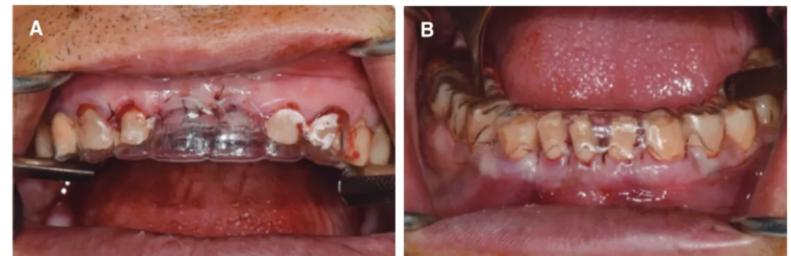 Fig. 11. Surgical template application and clinical crown lengthening procedure. (A) Application of surgical template on the maxillary anterior teeth, (B) Appli- Appli-cation of surgical template on the mandibular anterior teeth.