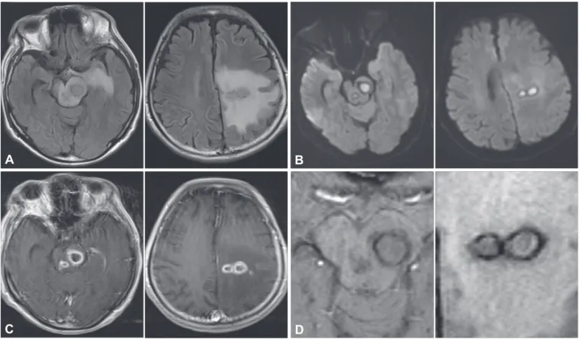 Fig. 1. Brain magnetic resonance imaging on admission. A: Fluid-attenuated inversion-recovery images disclosed iso- to hypointensity le- le-sions in the midbrain and left cerebral hemisphere with surrounding edema