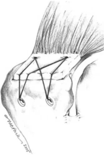 Fig. 2. Transosseous-equivalent repair 