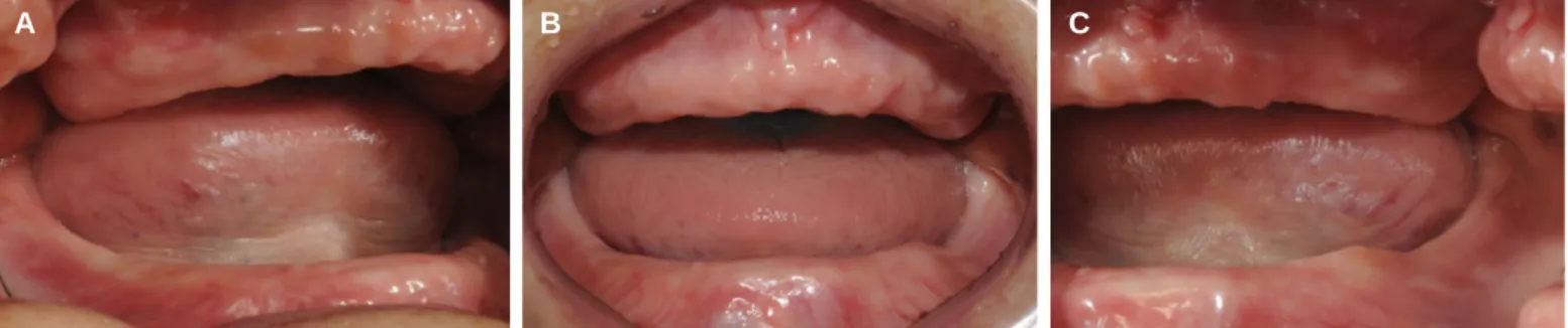 Fig. 2. Definitive impression making for (A) maxilla and (B) mandible.