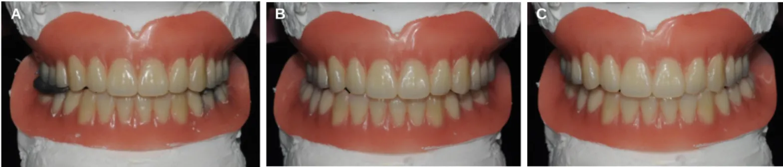 Fig. 5. Clinical remounting of definitive dentures at (A) centric relation, (B) eccentric position to right side, and (C) eccentric position to left side.