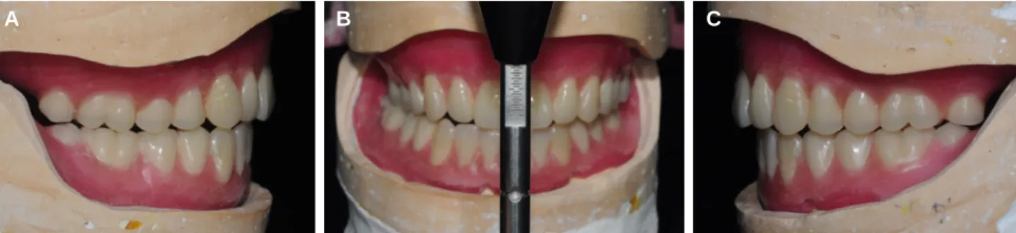 Fig. 9. Discrepancy between two registration methods, gothic arch tracing and chin point guidance