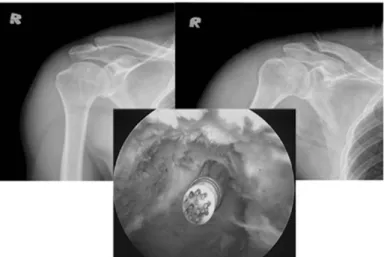 Fig. 2. Arthroscopic distal clavicle resection for osteoarthritis of acromioclavicular joint 