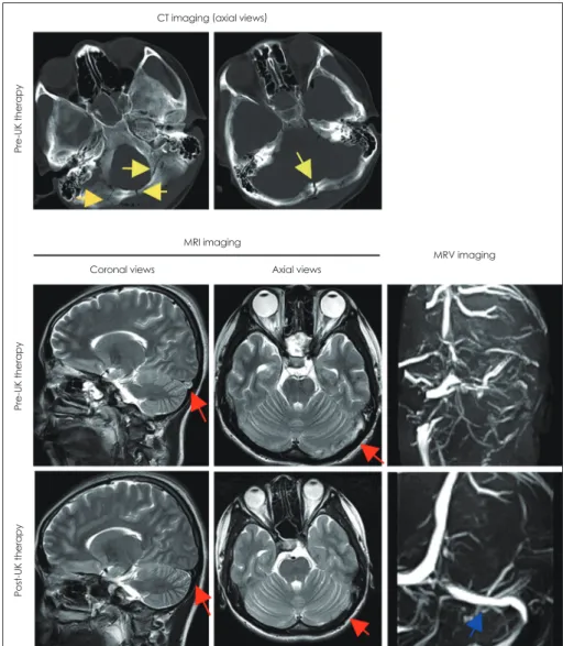 Fig. 2. Urokinase treatment for throm- throm-bosis of the left transverse sinus and  sigmoid sinus in a traumatic-brain-injury  patient