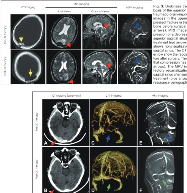 Fig. 3. Urokinase treatment for throm- throm-bosis of the superior sagittal sinus in a  traumatic-brain-injury patient