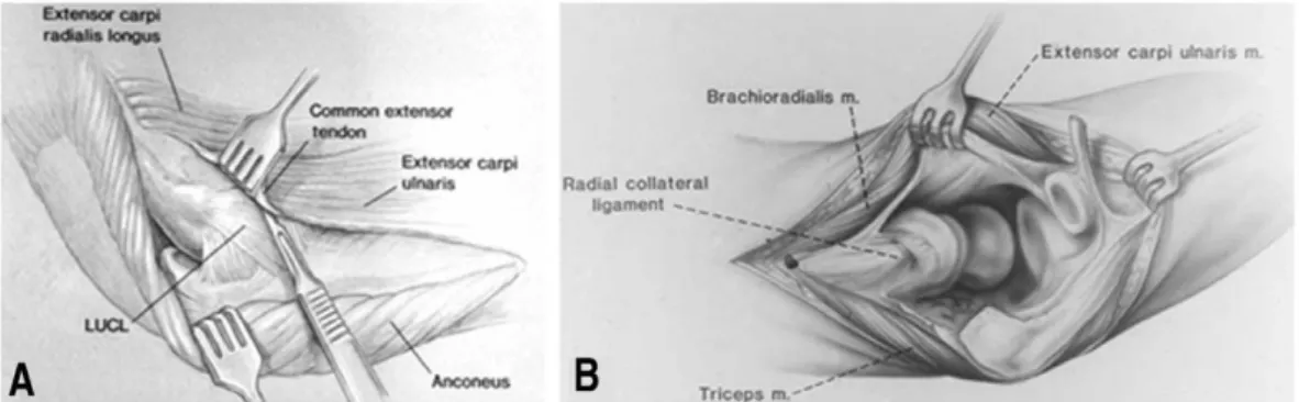 Fig 5. (A)  For interposition arthroplasty and for extensile approaches, a posterior skin incision typically is used