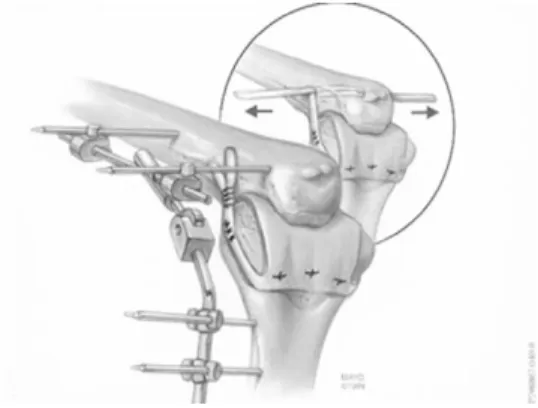 Fig. 6. Interpositional arthroplasty
