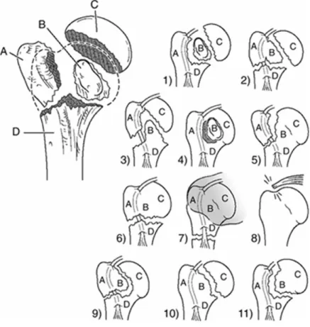 Fig. 1. 근위상완골 골절의 pattern에 대한 drawing (Codman 1934)
