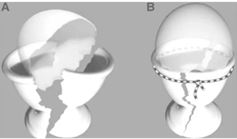 Fig. 3. Eggshell Model. 달걀 받침(결절)을 고정시켜 발생하는 테두리에 의해 불안정한 달걀껍질(상완골두)이 간접적으로 안정화된다 (Hertel 2005).