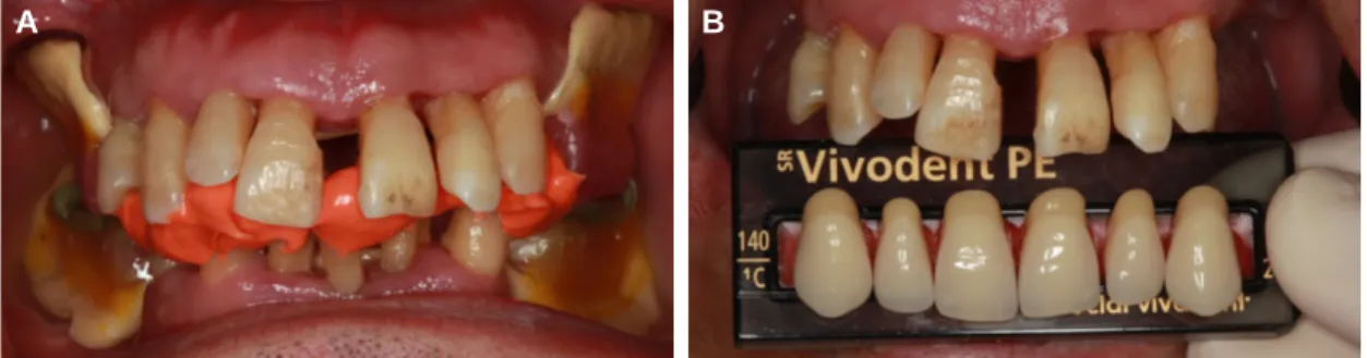 Fig. 4. (A) Bite registration, (B) Artificial teeth selection.