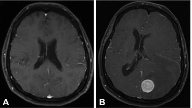 Fig. 2. Contrast-enhanced CT scan of the chest at the time of ad- ad-mission to the neurological intensive care unit