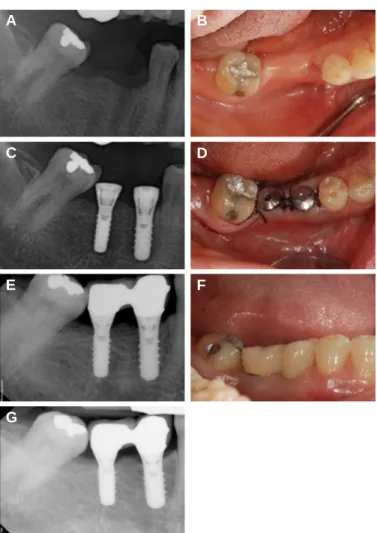 Fig. 1. Clinical pictures of case 1. (A), (B) after tooth extraction, (C), (D) implant surgery, (E), (F) the placement of definitive prosthesis, (G) 51-months follow up after the placement of definitive prosthesis placement.
