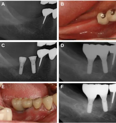 Fig. 2. Clinical pictures of case 2. (A) after old restoration removal, (B) implant surgery, (C), (D) the placement of definitive prosthesis, (E) 48-months follow up after the placement of definitive prosthesis placement.
