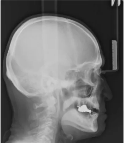 Fig. 6. Cephalometric view after increase of vertical dimension of occlusion.