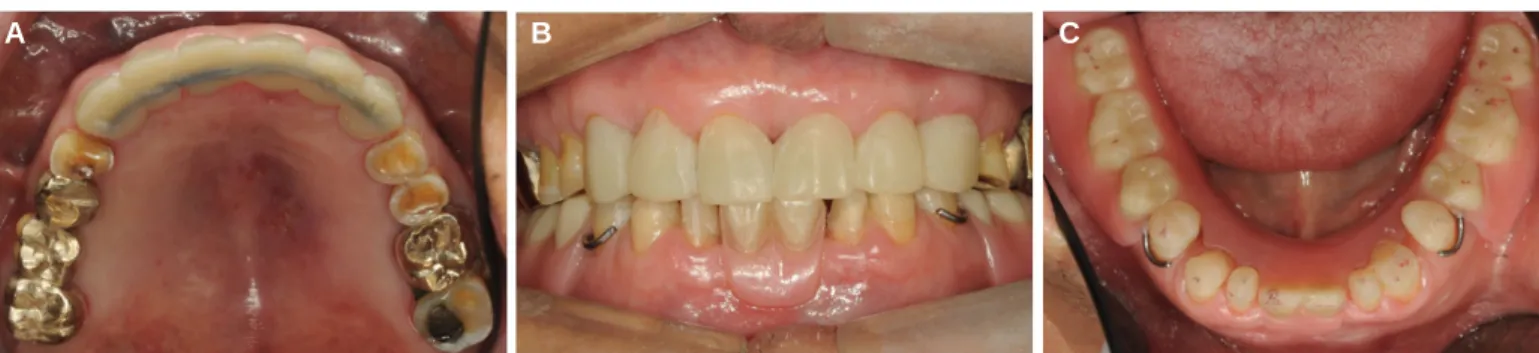 Fig. 12. Provisional restoration after use for 4 months. (A) Frontal view, (B), Occlusal view.