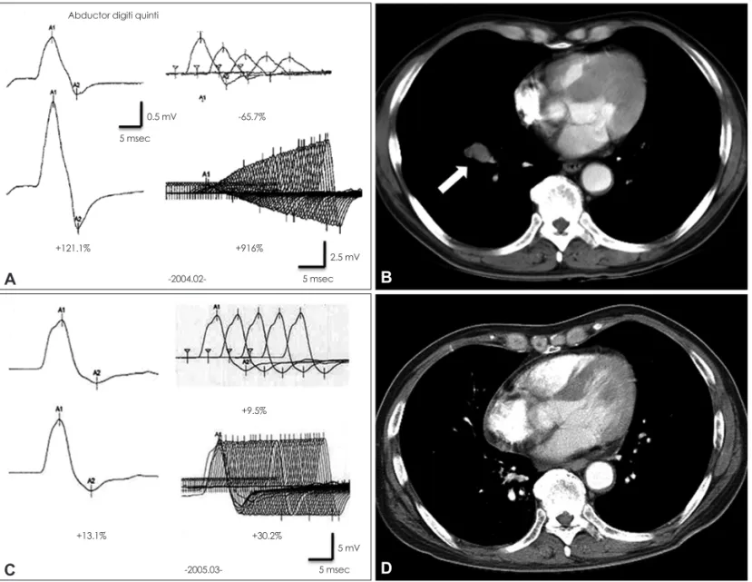 Fig. 1. Repetitive nerve stimulation test (RNST; A and C) and serial chest computed tomography (CT; B and D) and results before (A and B)  and after (C and D) cancer treatment