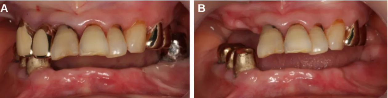 Fig. 2. Radiograph on first visit. (A) Periapical view of mandibular right premolars, (B) Panoramic view.