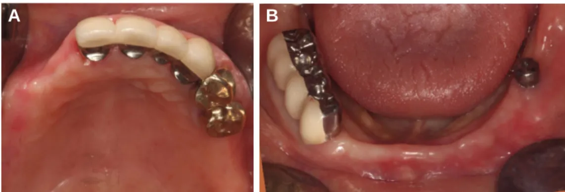 Fig. 5. PFM surveyed crown try-in. (A) Upper occlusal view, (B) Lower occlusal view.