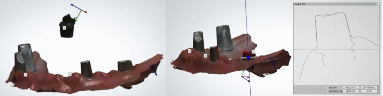 Fig. 15. Definite abutment form restored by abutment merging with pre-scanned abutment image.