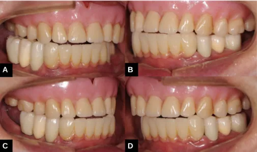 Fig. 19. Bilateral balanced occlusion. (A) Working side of lateral protrusion (Rt.), (B) Balancing side of lateral protrusion (Rt.), (C) Balancing side of lateral protrusion (Lt.), (D) Working side of lateral protrusion (Lt.).