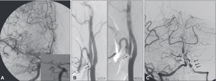 Fig. 1. Conventional cerebral angiogram. A: Right carotid angiogram showing severe focal stenosis in the midportion of the middle cerebral  artery (arrows) that is eccentric and irregular