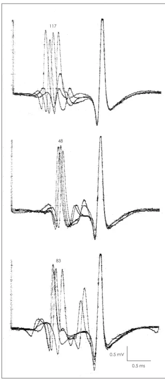 Fig. 1. Three single fiber potential pairs showing a marked jitter. 
