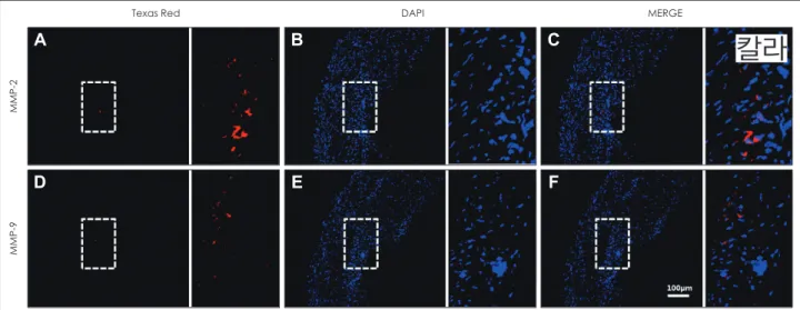 Fig. 3. Immunofluorescence staining illustrating the expressions of MMP-2 and MMP-9 produced by macrophages in carotid plaques