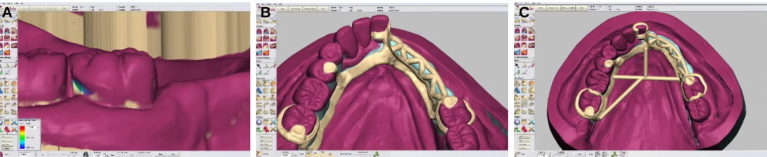Fig. 4. Removable partial denture framework designed by CAD. (A) The degree of undercut can be visualized by the different color scheme show on the diagram, (B) Complete design, (C) Additional structure was introduced to prevent distortion and deformation 