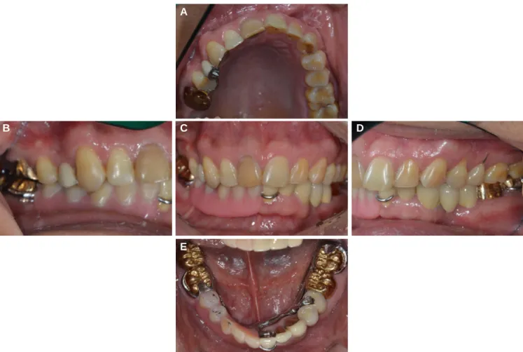 Fig. 7. Definitive prostheses. (A) Maxillary occlusal view, (B) Lateral view (right), (C) Frontal view, (D) Lateral view (left), (E) Mandibular occlusal view
