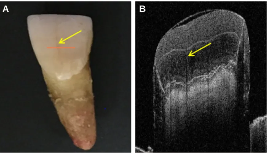 Fig. 6. Image obtained from a distinct enamel crack. (A) A photo examination of the enamel crack using transillumination(arrow) in which SS-OCT scanning was performed along the red line